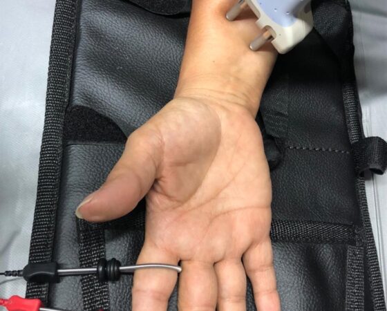 Electromiografía + Neuroconducción