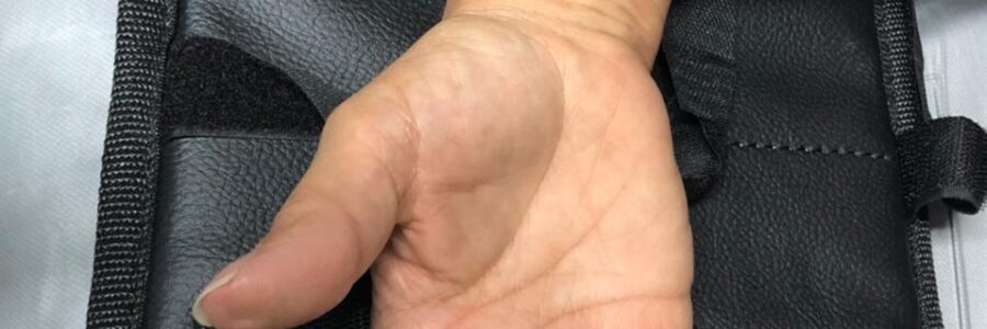 Electromiografía + Neuroconducción